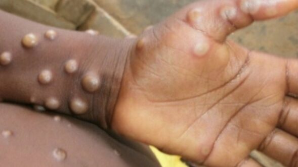 Suspected case of monkeypox in Kerela surfaces