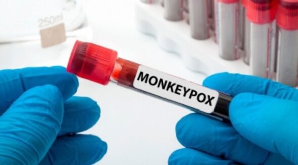 San Francisco declares state of emergency with increase in monkeypox